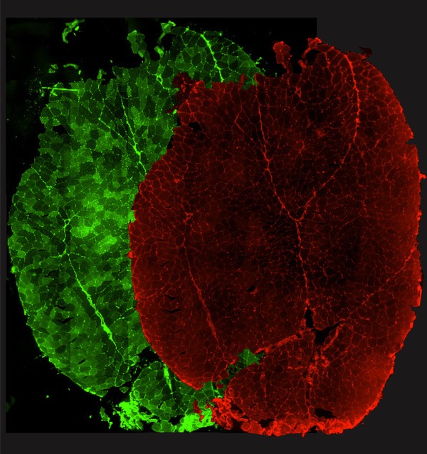 La Recherche (trimestriel n°579): Lorsqu’un mécanisme cellulaire compense une maladie rare